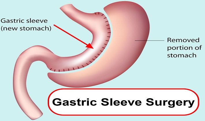 gastric sleeve surgery Melbourne