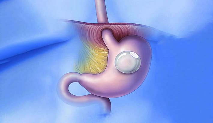 gastric balloon in Melbourne