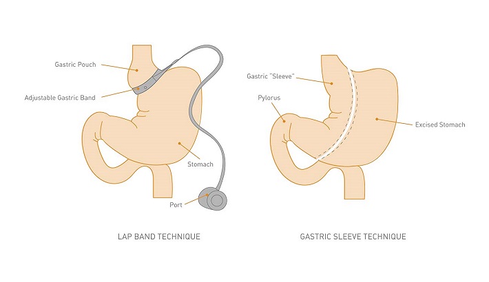  Gastric lap band surgery in Melbourne